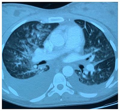 Post-partum <mark class="highlighted">Coronavirus Disease 19</mark> Like Pneumonia Before the COVID-19 Italian Pandemic Outbreak: A Case Report